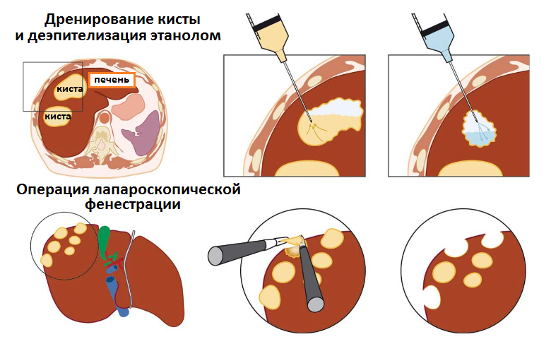 киста печени лечение