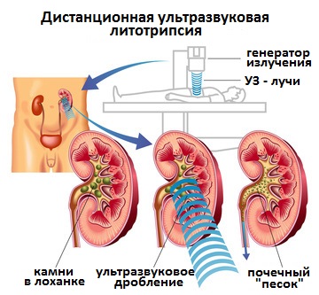 дистанционная литотрипсия