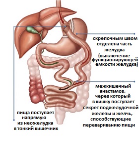 шунтирующая операция при ожирении