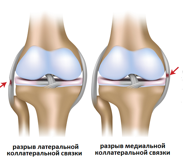 растяжение связок коленного сустава