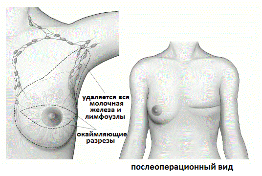 мастэктомия