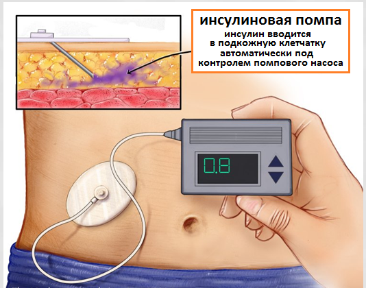 инсулиновая помпа