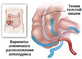 варианты анатомического расположения червеобразного отростка