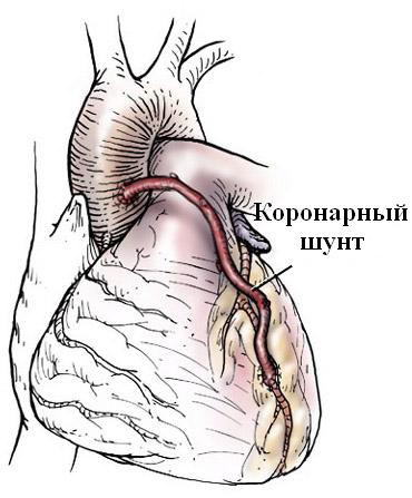 аортокоронарное шунтирование