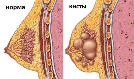 фиброзно-кистозная мастопатия