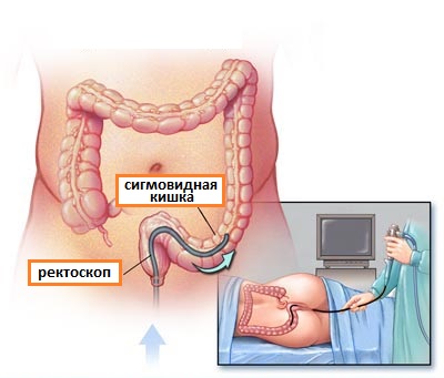 сигмоскопия