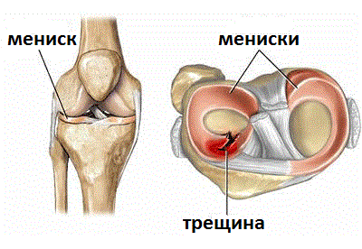 повреждение мениска