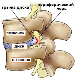 радикулит причина