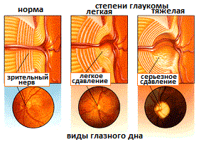 степени глаукомы