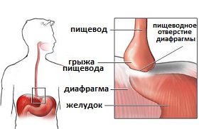 грыжа пищеводного отверстия диафрагмы