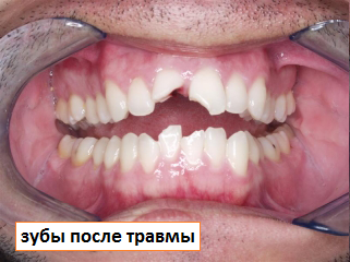 зуб после травмы