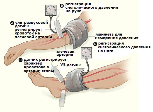 измерение ИЛД при хромоте
