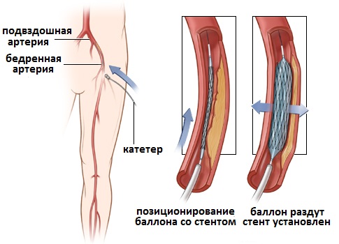 стентирование подвздошных артерий