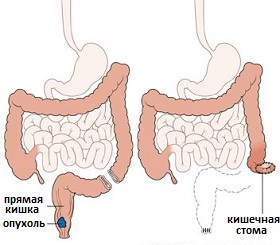 колоностомия при раке толстой кишки