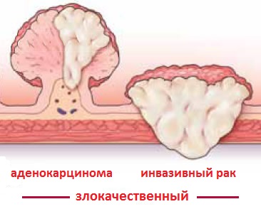 злокачественный полип кишки
