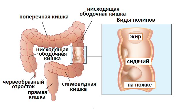 виды полипов по форме