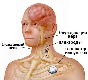 операция имплантации стимулятора блуждающего нерва