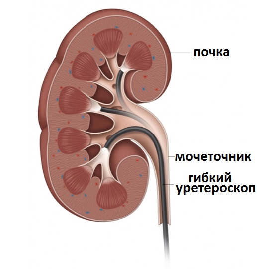 уретероскопия