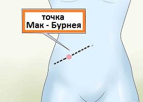 точка Мак-Бурнея при аппендэктомии