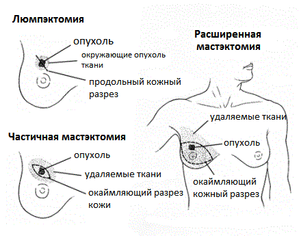 операции при раке молочной железы