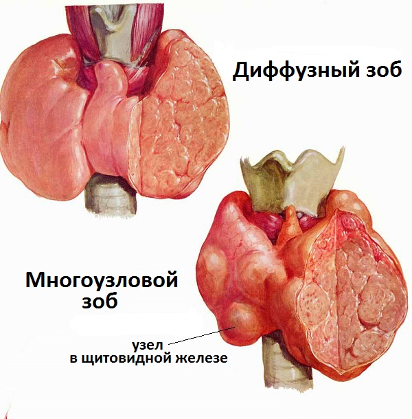 узловой зоб