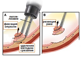 эндоскопическая резекция рака желудка и биопсия