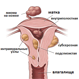 виды миомы матки