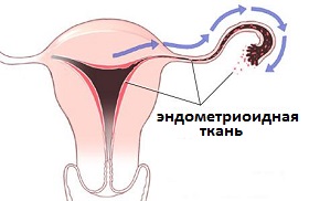 распространение эндометриоидной ткани
