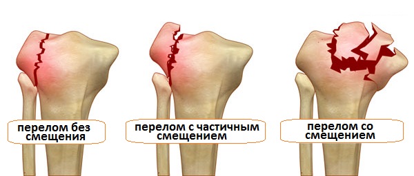 перелом большеберцовой кости