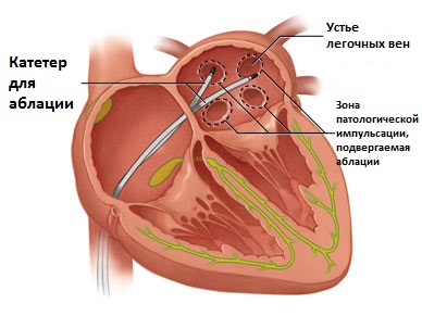 лечение фибрилляции предсердий аблацией