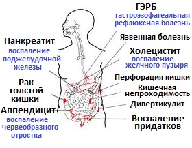 боли в животе и возможные причины абдоминальной боли