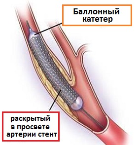 стентирование сонной артерии