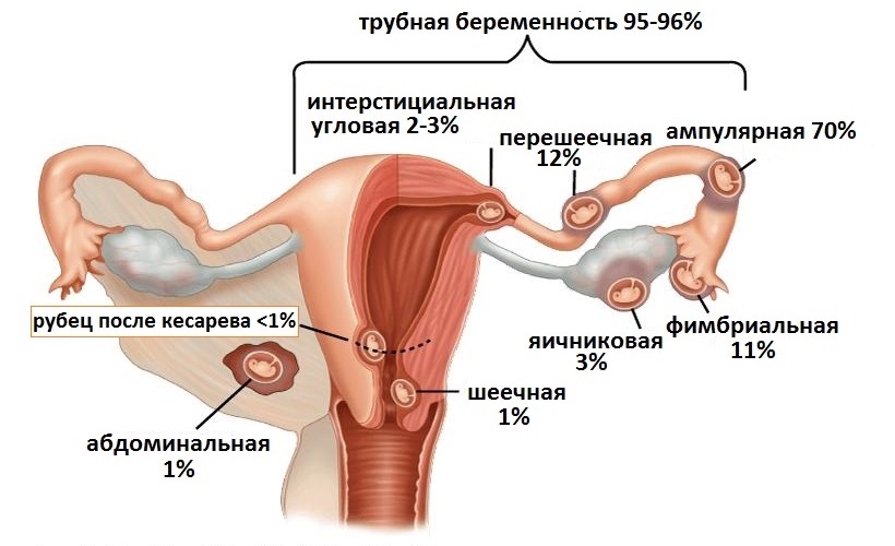 виды внематочной беременности
