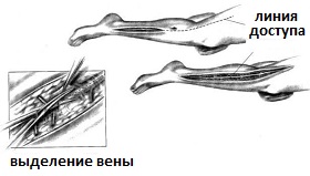 доступ для забора вены для АКШ