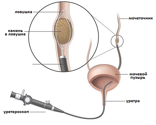 эндоскопическая литоэкстракция