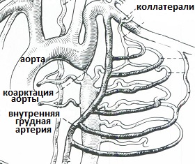 коллатерали при коарктации аорты