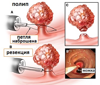 после удаления полипов толстой кишки