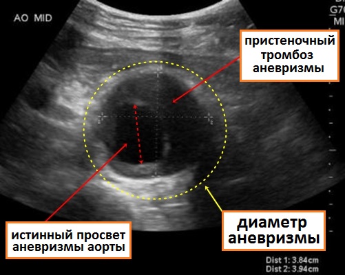 узи аневризмы брюшной аорты поперечный срез