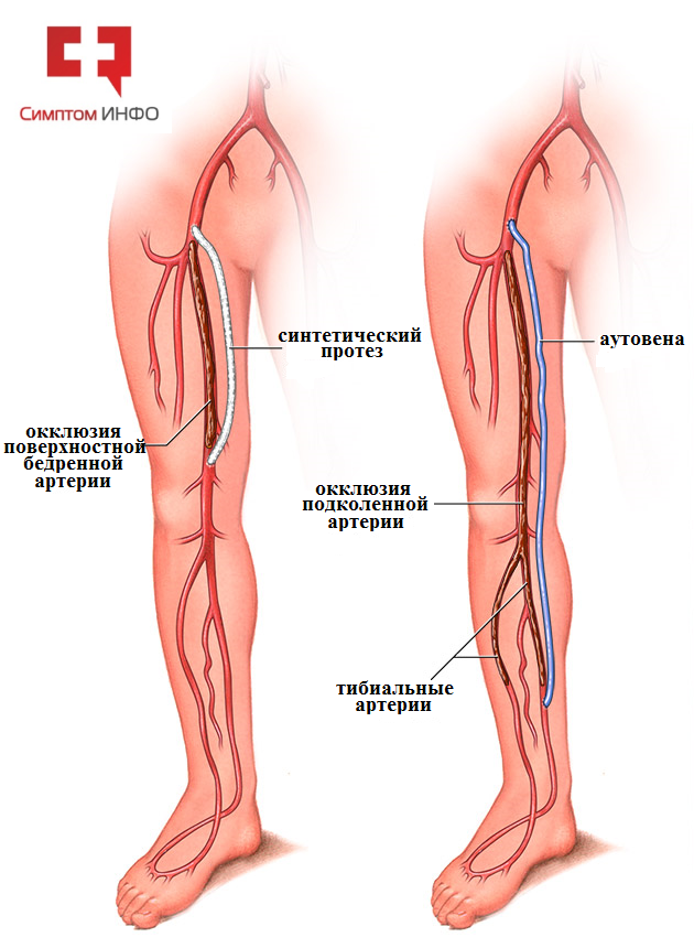 бедренно-подколенное шунтирование