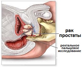 ректальное пальцевое исследование
