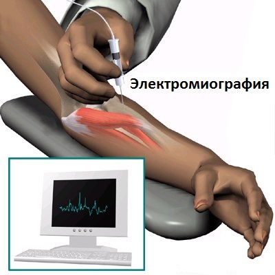 электромиография при СГВ
