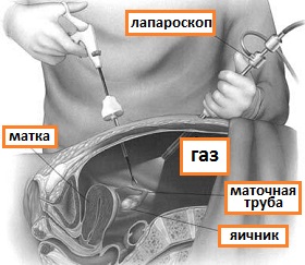 лапароскопия при эндометриозе