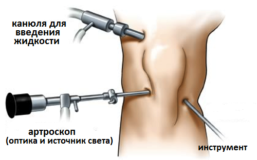 артроскопия