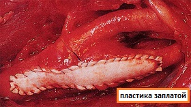 каротидная эндартерэктомия с пластикой заплатой