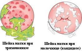 молочница шейки матки