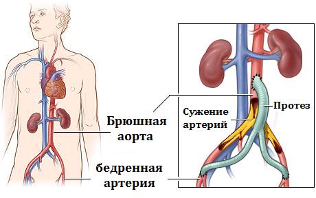 аортобедренное бифуркационное шунтирование