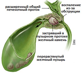 приступ калькулезного холецистита