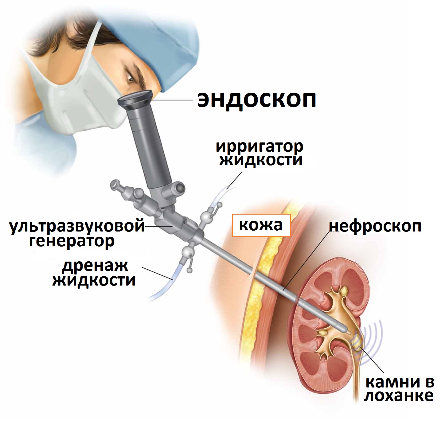 эндоскопическая нефролитотомия