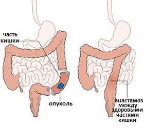 операция резекции сигмовидной кишки