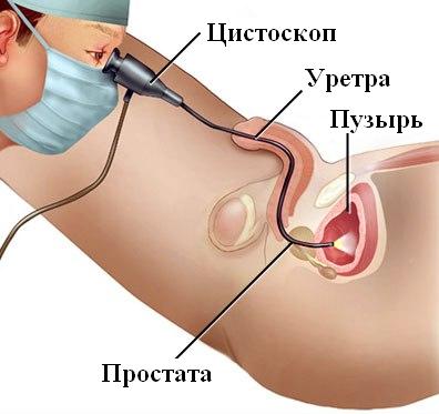 цистоуретероскопия